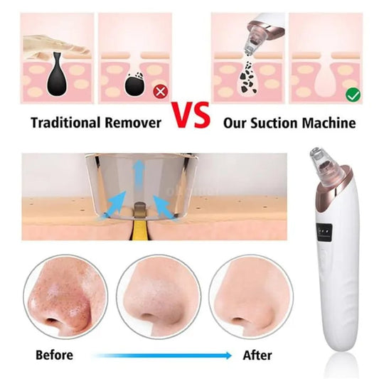 Nose & Face Electric Vacuum Suction Blackhead Remover Pore Cleaner